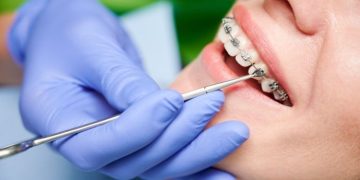 Braces and Beyond: Exploring Your Options for Orthodontic Treatment in Surrey