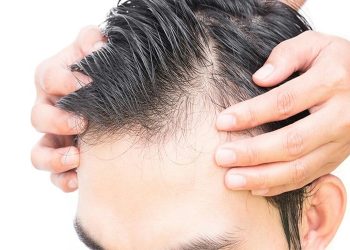 Balding In Your 20s? Try Out Natural-Looking Hair Systems