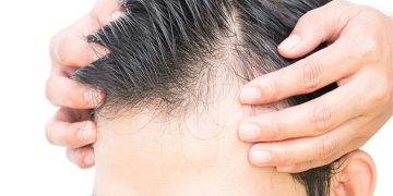 Balding In Your 20s? Try Out Natural-Looking Hair Systems
