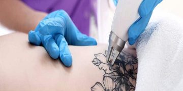 Say Goodbye to Regrets: The Art of Laser Tattoo Removal