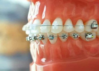 The Lifelong Benefits of Teeth Straightening Techniques