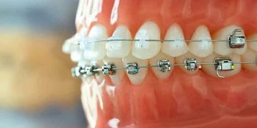 The Lifelong Benefits of Teeth Straightening Techniques