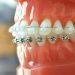 The Lifelong Benefits of Teeth Straightening Techniques