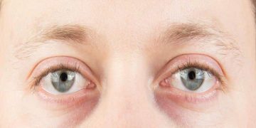 5 Compelling Reasons for Juvederm on Eye Bags and Dark Circles