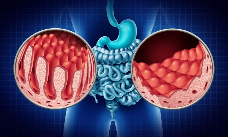 Deciphering Celiac Disease Unraveling The Intricacies Of Gluten Sensitivity 