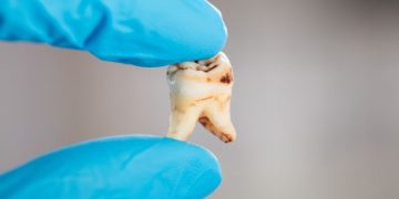 New Details on the Ongoing Suboxone Tooth Decay Lawsuit