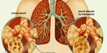 Breathing Troubles: Tracing the Origins of Lung Diseases
