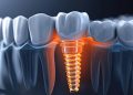 Restoring Confidence One Tooth at a Time: Exploring Implant Solutions