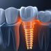 Restoring Confidence One Tooth at a Time: Exploring Implant Solutions