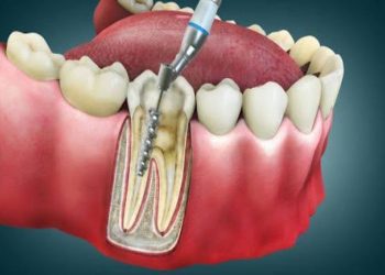 Why Dental Implants Are a Game-Changer for Oral Health