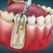 Why Dental Implants Are a Game-Changer for Oral Health