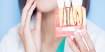 Reasons To Get Dental Implants That Aren’t Aesthetic