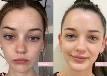 How Many Laser Sessions Do You Need for Pigmentation?