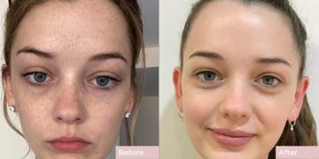 How Many Laser Sessions Do You Need for Pigmentation?