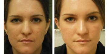 Smooth Again: The New Era of Acne Scar Treatment