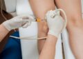 Foam Sclerotherapy in Dubai Advanced Varicose Vein Treatment