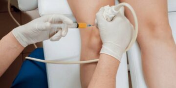 Foam Sclerotherapy in Dubai Advanced Varicose Vein Treatment